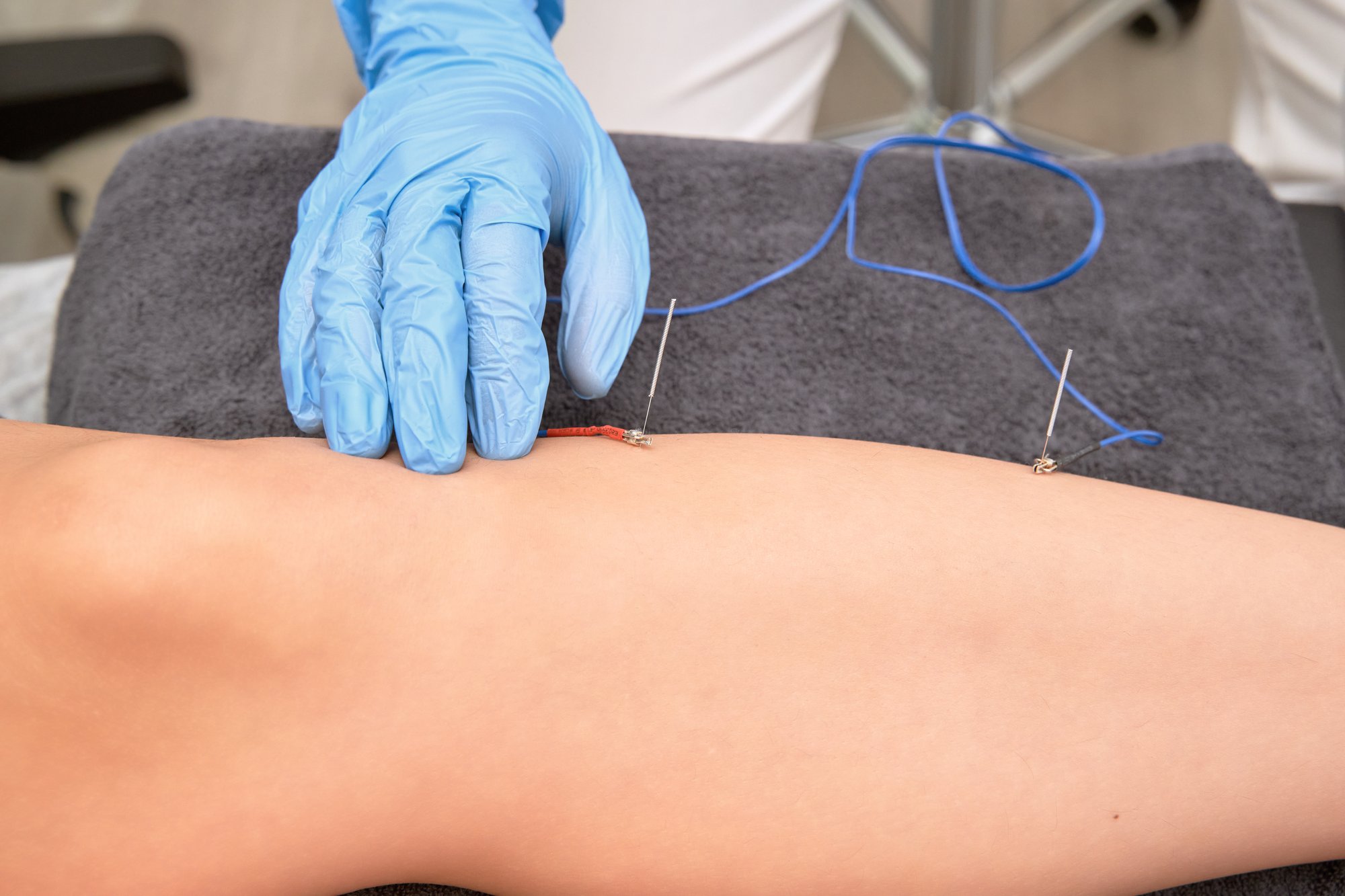 hands-of-physiotherapist-placing-electroacupunctur-2024-11-26-14-48-20-utc